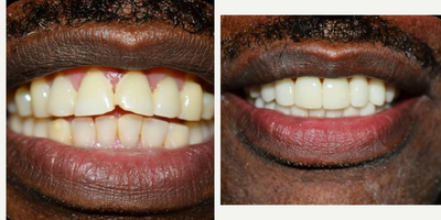 Man treated with Porcelain Veneers, Dental Implants - Man treated with Porcelain Veneers, Dental Implants