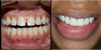 Man treated with Dental Implants, Porcelain Veneers - Man treated with Dental Implants, Porcelain Veneers