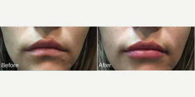 25-34 year old woman treated with Injectable Fillers - Patient had 1cc syringe of Juvederm Ultra to get beautiful and natural results.