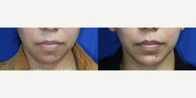 Woman treated with Neck Lift, Facelift, Chin Liposuction - Here is an early one-month post-op result on our wonderful patient who underwent a FaceologyLIFT and Chin Augmentation. The synergistic effect of these two procedures resulted in a beautifully defined neckline and jawline contour, with more balance to her profile.