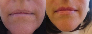 Lips  - 
	Full lip
