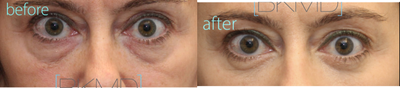 Lower blepharoplasty with fat grafting for eye bags and dark circles - Dr. Kotlus performed a transconjunctival lower blepharoplasty to reduce the under-eye bags plus fat grafting to fill in the hollows at the upper cheek/eyelid junction.
