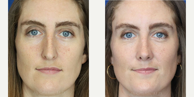 Woman treated with Rhinoplasty - Rhinoplasty
