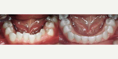 18-24 year old woman treated with DNA Appliance - DNA Appliances can do some phenomenal work for the teeth!