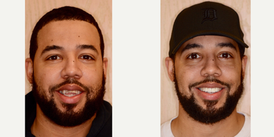 25-34 year old man treated with Six Month Smiles - When teeth are misaligned and not as ideal due to bad positioning, chipping and trauma, then a combination approach using Orthodontics and Porcelain Veneers may be the solution.