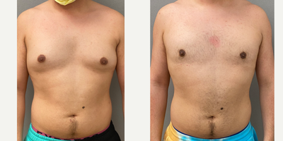 25-34 year old man treated with Gynecomastia Surgery - 26 yo s/p male breast reduction performed under sedation in our on site AAAA certified operating suite