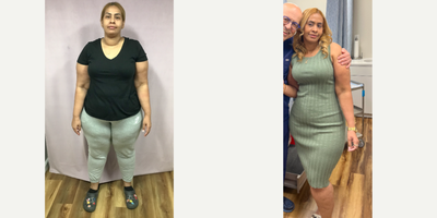 25-34 year old woman treated with Endoscopic Sleeve Gastroplasty - She lost 75 LBS in 1 year after her Endoscopic Sleeve Sututre Sculpt weight loss procedure.