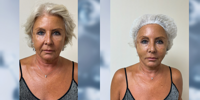 65-74 year old woman treated with Nonsurgical Facelift, Thread Lift, Nonsurgical Neck Lift, Botox - Dr. Golberg is renowned for his holistic approach. The G-Lift procedure he offers not only lifts the lower third of the face but also uses bio-stimulating agents to enhance the upper areas. This comprehensive method ensures a balanced and rejuvenated appearance. In just one hour, the G-Lift can deliver remarkable results, combining thread lifts with bio-stimulation for a youthful transformation.