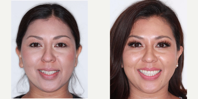Woman treated with Braces - Woman treated with Braces.