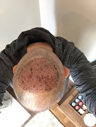 36 Years Old Hair Transplant Turkey 4600 Grafts Review Realself