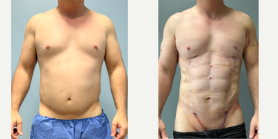 47 year old man treated with Abdominal Etching, Liposuction, Vaser Liposuction - The daddy do-over procedure. The procedure involved use of Vaser liposuction, Renuvion skin tightening. Before and after 2 days, then 4 weeks and then 6 months after competing in a body building contest.