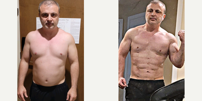 47 year old man treated with Abdominal Etching, Liposuction, Vaser Liposuction - The daddy do-over procedure. The procedure involved use of Vaser liposuction, Renuvion skin tightening. Before and after 2 days, then 4 weeks and then 6 months after competing in a body building contest.