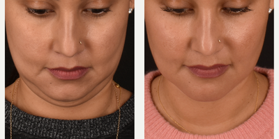 35-44 year old woman treated with Buccal Fat Removal, Chin Liposuction, Facial Fat Transfer, Mini Neck Lift - Deep Neck Liposuction and Lift, Buccal Fat Removal and Fat Harvest and Transfer to Chin, Mid-Face, Under-Eyes & Temples