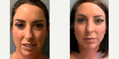 25-34 year old woman treated with Deep Plane Facelift - Dr. Daddy K HiDef (Deep Plane) Facelift