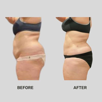 45-54 year old woman treated with Fun Sculpting HD Lipo - 45-54 year old woman treated with Fun Sculpting HD Lipo of the abs and flanks (belly and sides). Photo was taken 90 days later. Patient down 4 inches in 1 treatment.