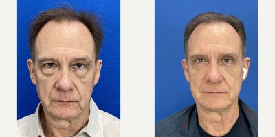 Man treated with Eyelid Surgery, Dysport - Upper and lower blepharoplasty with Dysport on forehead