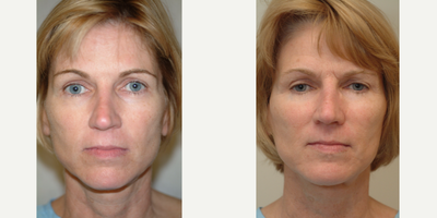 55-64 year old woman treated with Cheek Lift - 4 years after Cheeklift which is done in the office under sedation.
