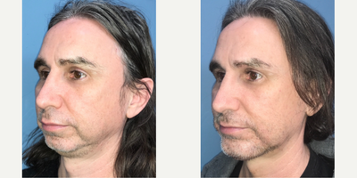 45-54 year old man treated with Chin Implant - Patient had a chin implant placed