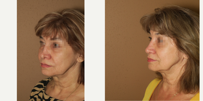 45-54 year old woman treated with Revision Rhinoplasty - Revision rhinoplasty after 2 other surgeons - tip refinement