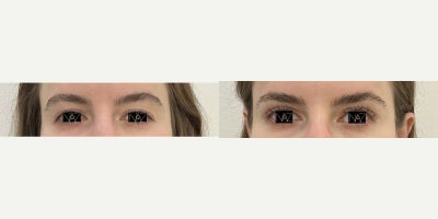 25-34 year old woman treated with Eyelid Surgery, Ptosis Surgery - Bilateral upper eyelid blepharoplasty and left ptosis repair