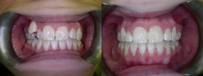 Treatment of blocked out  upper eye tooth with braces (orthodontics) - 
	Treatment of blocked out upper eye tooth with braces (orthodontics)
