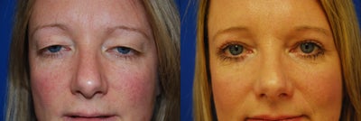 Eyelid Surgery/Upper Lid Blepharoplasty - 
	This patient underwent a bilateral upper lid blepharoplasty (eyelid surgery).
