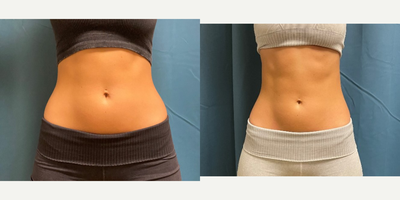 25-34 year old woman treated with Emsculpt - Amazing results in just 3 months on Emsculpt