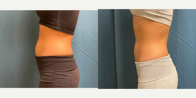 25-34 year old woman treated with Emsculpt - Amazing results in just 3 months on Emsculpt