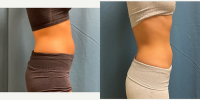 25-34 year old woman treated with Emsculpt - Amazing results in just 3 months on Emsculpt