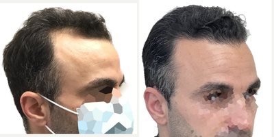 38 year old man treated with FUE Hair Transplant and Minoxidil - This is a 38-year old male with progressive, androgenetic hair loss starting at about age 18. He was on finasteride for about 10 years when it first started but stopped at about age 28 because he just felt that he didnt want to be on oral medication anymore. Unfortunately, though, once he stopped the finasteride, his hair started falling out.More recently hed started daily minoxidil which was working well to prevent any more hair loss, but as expected, it didnt do anything to regrow the deepening recessions on both sides of his hairline. He was seeking restoration with surgery. You can really see those recessions once we shaved his head just prior to getting started. At the same time, he wanted a little more density behind his hairline in the frontal scalp, as well as a few grafts scattered over the crown, just to add a slight bit of density there.He had a 2461 graft FUE, with most of the grafts allotted to filling those recessions on either side of his hairline. We also added a few through the remainder of the frontal scalp and just a small amount in the crown.Hes had a great result! The recessions are restored and his hairline looks really natural! Hes still using his daily minoxidil to prevent ongoing hair loss and this is the kind of restoration that will age with him really naturally for decades to come. Even though we extracted more than 2400 grafts, weve done it in such a way that his donor area still looks really full. Youd really never be able to tell that this patient had a hair transplant!