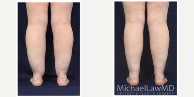35-44 year old woman treated with Calf Reduction - Lower leg liposuction. Follow-up photo taken 6 months after the procedure.