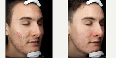 18-24 year old man treated with Photodynamic Therapy - PDT on cheeks