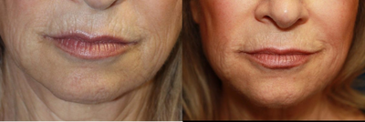 Woman treated with Collagen Injection - Woman treated with Collagen Injection