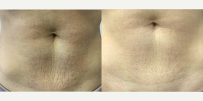 35-44 year old woman treated with Microneedling RF - Patient was treated with Microneedling with RF for stretch marks on tummy after her second child birth. Photo shows improvement after the 2nd treatment. She is very happy and lives overseas. She left after the 3rd treatment was done. More improvement usually occurs as the body continues to produce more collagen over 6-12 months. She is also using Alastin restorative complex to build elastic fibers and collagen as a response to the Microneedling with RF.