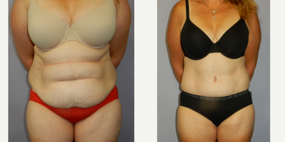 45-54 year old woman treated with Post-Pregnancy Procedures - 50 yo female requesting abdominoplastyDr Damien Grinsell Registered medical practitioner, specialist plastic surgeon(Speciality registration in surgery - plastic surgery)AHPRA Registration: MED0001207555Any invasive procedure carries risks and individual results may vary depending on genetic factors, not limited to but including age, genetics, diet, lifestyle and existing medical conditions. Outcomes shown are only relevant to this patient and do not necessarily reflect the results other patients may experience. Before any surgery, we recommend you consult a qualified health practitioner who should discuss at length these risks, including possible outcomes and recovery/aftercare instructions specific to your procedure. If unsure, always seek a second opinion from a specialist plastic surgeon.