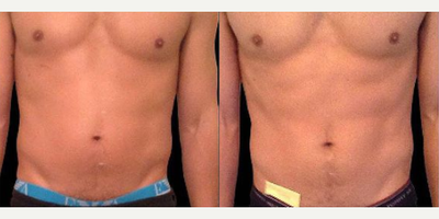 Man treated with Emsculpt - Man treated with Emsculpt
