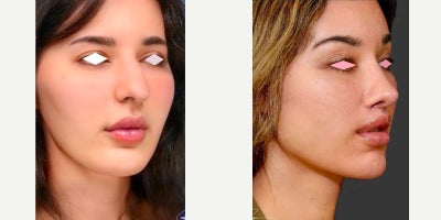 25-34 year old woman treated with Facelift, Rhinoplasty, Lip Lift, Facial Fat Transfer, Brow Lift - Young woman who underwent an endoscopic mid-face lift, rotational endoscopic brow lift, lip lift, fat transfer and rhinoplasty