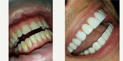 35-44 year old man treated with Zoom Whitening - laser teeth whitening.