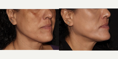 45-54 year old woman treated with SkinPen, Chemical Peel, DiamondGlow - Patient was treated for sun damage and melasma using PRP SkinPen, Chemical peels, and finishing with a DiamondGlow Facial.
