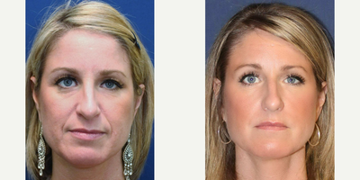 Bellafill | Artefill at 6 Months - I want to look less old and less tired was what this woman said prior to being treated with Artefill or Bellafill.  A canula techniue was used to airbrush the volume back to under her eyes and to correct her deep laugh lines.  She chose the long term filler Artefill, now known as Bellafill, because she does not like needles and injections and she did not want to come back every year or so like she would have had to if she had had a product like Juvederm or Restylane.