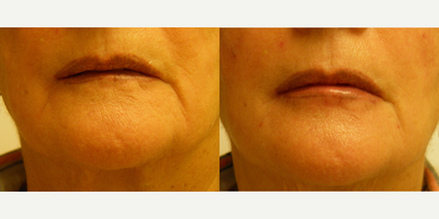 65-74 year old woman treated with Vampire Facelift - This is a 70 yo female who received only 1 injection of the Vampire Facelift. Special attention was paid to the perioral area since her lip contour was tattoo-ed in the past and contrasted with the rest of her face. The chin, the lower lip, the upper and lower perioral lines, and the Marionette lines were treated restoring a youthful aspect of the lower face. Post treatment the old tattoo-ed lines matched better the rest of the face mimicking a lip liner contour.