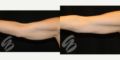 70 year old woman treated with Evolve Tite - 70 year old woman treated with Evolve Tite for skin tightening on arms