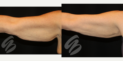 63 year old woman treated with Evolve Tite and CoolSculpting on Arms - 63 year old woman treated with Evolve Tite and CoolSculpting on Arms