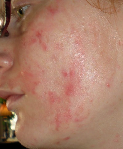 Are the Red Raw Spots Normal After 35% TCA Peel? Doctor Answers, Tips