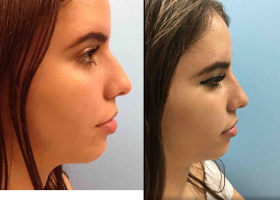 18-24 year old woman treated with Non Surgical Nose Job - 21 yo who wanted a correction of her #nose without surgery. I injected Restylane for a nice correction