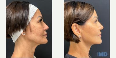 45-54 year old woman treated with NeoGen Plasma, Skin Tightening, Skin Rejuvenation - 90 days post, this lovely patient is enjoying her NeoGen results.