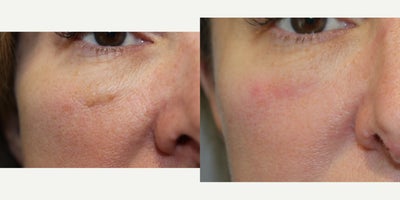 45-54 year old woman treated with Scar Removal, Subcision - 13358: Skin Erase- right upper cheek52 yo, F, 57, 125lbs, G2P2