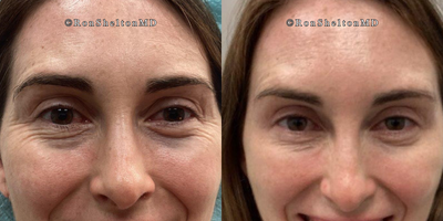 45-54 year old woman treated with Daxxify - 2 Weeks after Daxxify for wrinkles under her eyes when smiling. Daxxify provided a significant improvement.