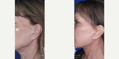 Woman treated with Deep Plane Facelift, Brow Lift - This lovely patient had a previous facelift but was bothered by persistent jowls and neck bands.She was also unhappy with the appearance of her nose and the scarring from her previous facelift.She now absolutely loves her new look which was achieved through 1 single transformative procedure that included my extended deep plane facelift, lateral brow lift, lip lift, and open rhinoplasty.