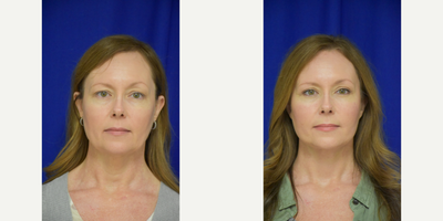 2775 45-54 year old woman treated with Facelift, Brow Lift, Buccal Fat Removal, Eyelid Surgery, Facial Fat Transfer - 45-54 year old woman treated with Facelift, Neck Lift, Facial Fat Transfer, Eyelid Surgery